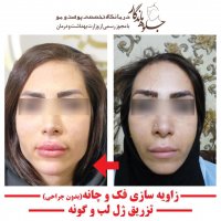 نمونه و عکس تزریق انواع فیلر، ژل، بوتاكس و چربی 